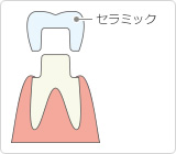 オールセラミック