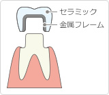 メタルボンド