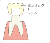 ハイブリッドセラミックス