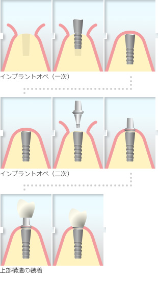 インプラント治療の流れ