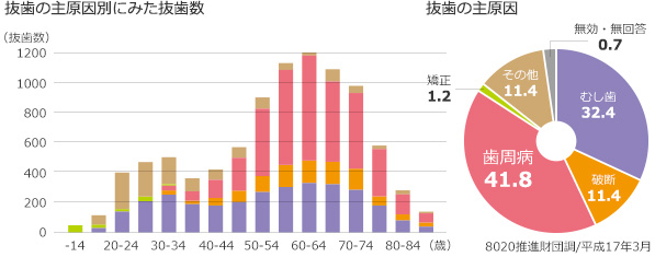 抜歯の原因