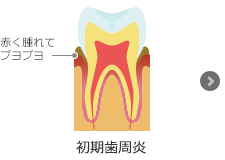 初期歯周炎