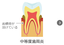 中等度歯周炎