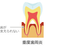 重度歯周炎